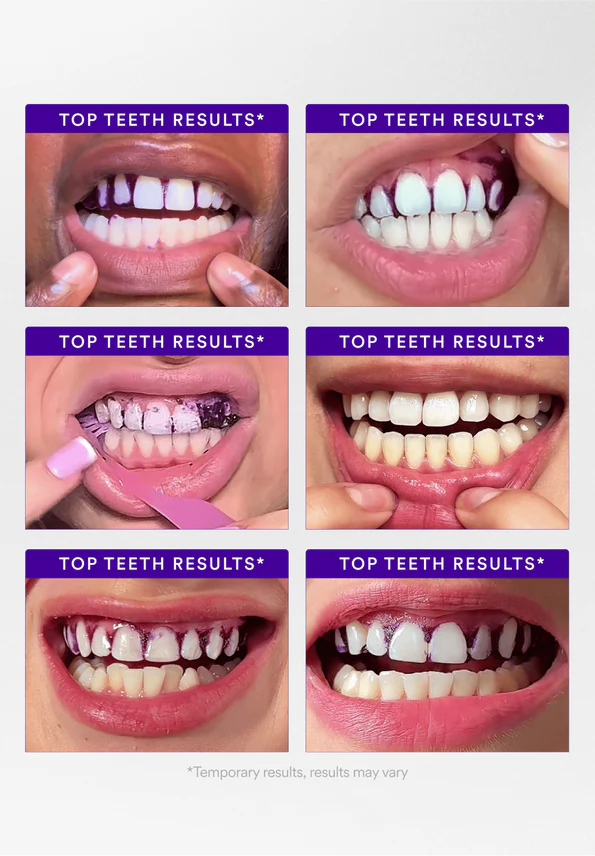 V34 Teeth Whitening Strips – Whiter Teeth in 30 Minutes